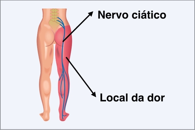 Dor nervo ciático